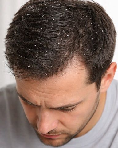 Dandruff Treatment